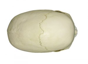 Scaphocephalic skull - Image 5
