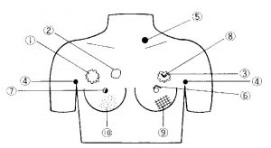 Breast Cancer Palpation Model