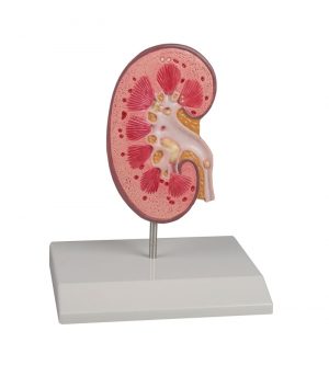 Kidney Stone Model