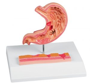 Stomach Cancer Model