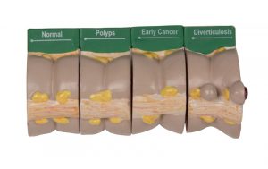 4 Piece Colon with Diseases - Image 2