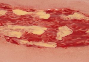 Wound Moulage Venous Leg Ulcer Large Exudation Phase - Image 3