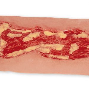 Wound Moulage Venous Leg Ulcer Large Exudation Phase