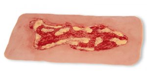 Wound Moulage Venous Leg Ulcer Large Exudation Phase - Image 4