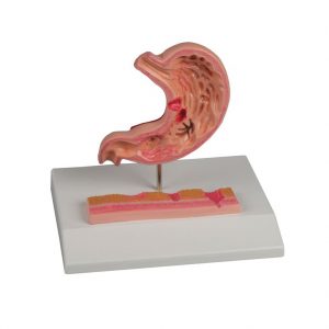 Stomach with Ulcers