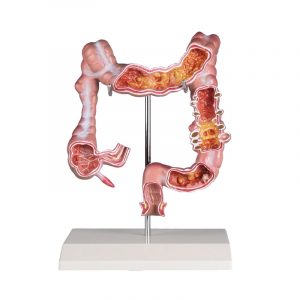 Colon Model with Diseases