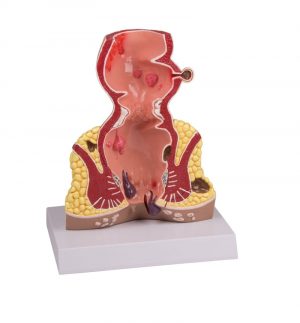 Rectum 1.5 Times Life Size