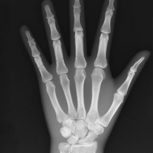 X Ray Phantom Hand Opaque