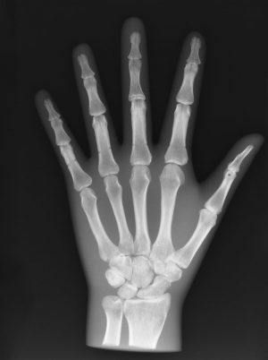 X Ray Phantom Hand Opaque