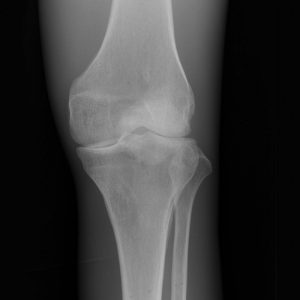 X Ray Phantom Knee Opaque
