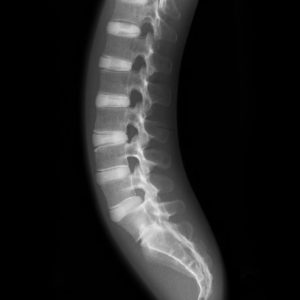 X Ray Phantom Spine Opaque
