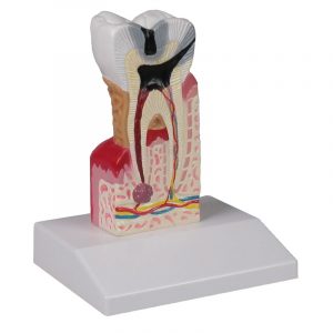 Dental Caries Model 10 Times Life Size