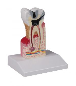 Dental Caries Model 10 Times Life Size
