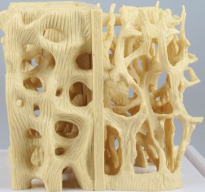 Healthy Osteoporotic Bone Structure Comparison Model - Image 2