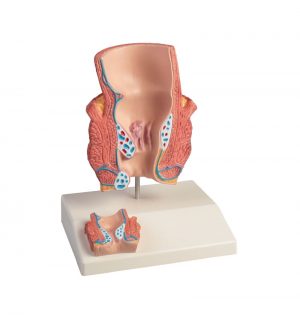 Haemorrhoids Model