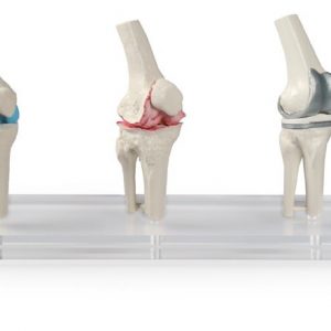 Knee Implant Model