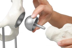 Hip Joint with Resurfacing Implant
