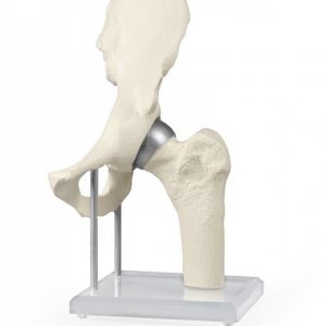 Hip Joint with Resurfacing Implant
