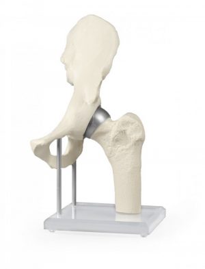 Hip Joint with Resurfacing Implant