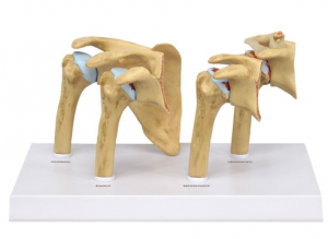 4 stage Osteoarthritis OA Shoulder
