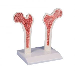 Osteoporosis Femur