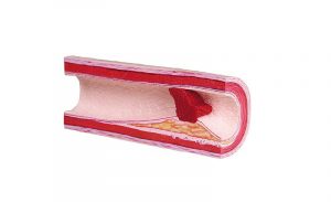 Atherothrombosis Model with Removable Trhrombus