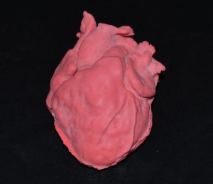 Pediatric Heart with Ventricular Septal Defect VSD G550EZ - Image 3