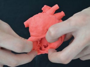 Pediatric Heart with Atrial Septal Defect ASD G560EZ - Image 2