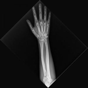 X Ray Phantom Lower Arm Opaque