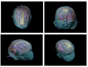 Simple Newborn Head Phantom for Ultrasonography Training - Image 2