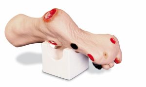 Wound Foot
