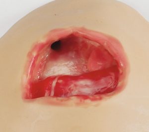 Negative Pressure Wound Therapy NPWT Trainers - Image 3