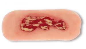 Wound Moulage Venous Leg Ulcer Small Exudation Phase
