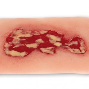 Wound Moulage Venous Leg Ulcer Small Exudation Phase