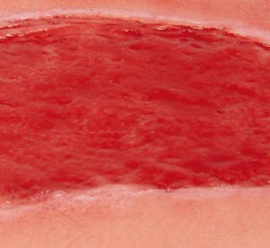 Model Arterial Leg Ulcer Granulation Phase Large Size - Image 3