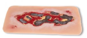 Model Arterial Leg Ulcer Exudation Phase Large Size