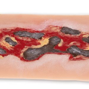 Model Arterial Leg Ulcer Exudation Phase Large Size