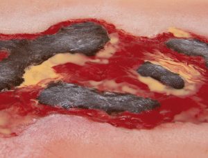 Model Arterial Leg Ulcer Exudation Phase Large Size - Image 4