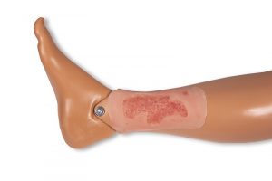 Model Arterial Leg Ulcer Epithelization Phase Small Size - Image 2