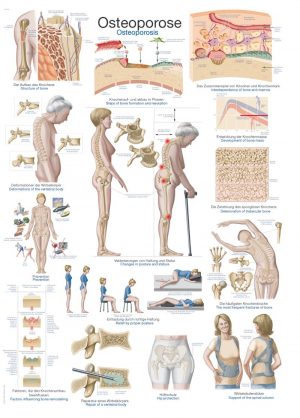 Anatomy Board Osteoporosis 50x70cm