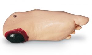 Edema Foot with Deep Tissue Injury for GERI KERI - Image 4