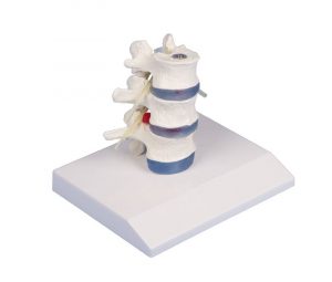 Lumbar Vertebrae with Prolapsed Inter Vertebral Discs MA02306