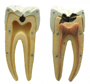 Tooth Model with Caries Two Part