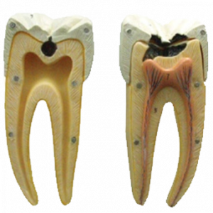 Tooth Model with Caries Two Part