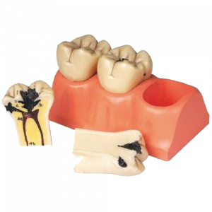 Dental Caries Model 3 Sections 6 Parts