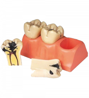 Dental Caries Model 3 Sections 6 Parts