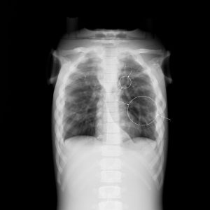 Pediatric Full Body x-ray Phantom of a Child with Fractures