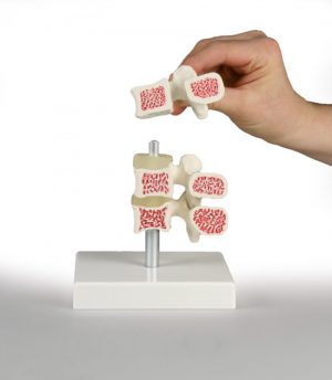 Osteoporosis Vertebrae Model 3 Vertebrae - Image 2