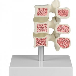 Osteoporosis Vertebrae Model 3 Vertebrae