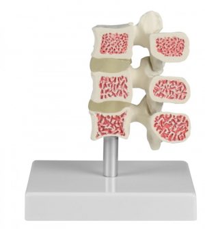 Osteoporosis Vertebrae Model 3 Vertebrae